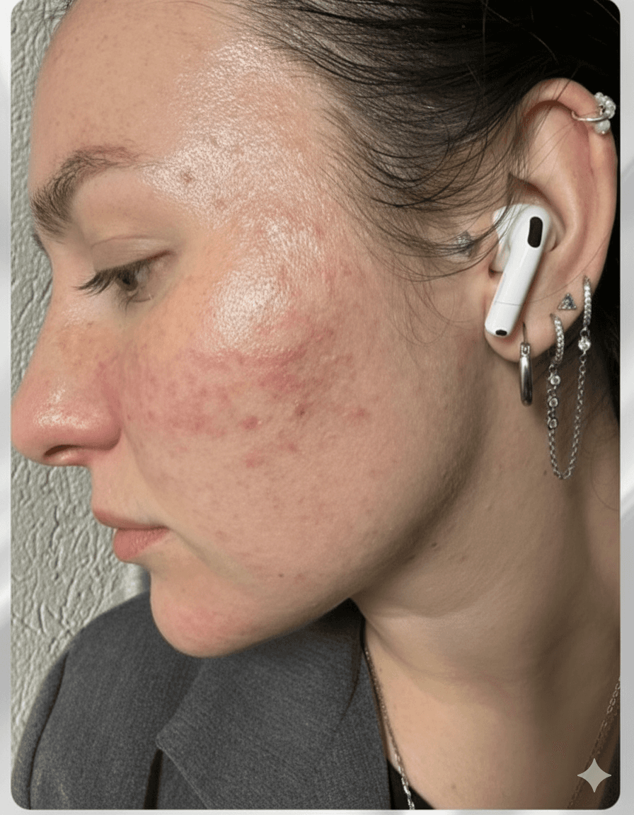 טיפול פנים לאקנה ועור מגורה - ניקוי עמוק בקריית ים