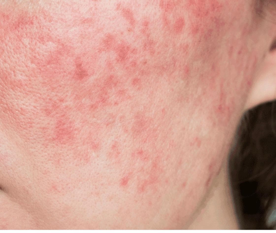 טיפול רוזציאה ואדמומיות - קוסמטיקאית מומחית לעור רגיש