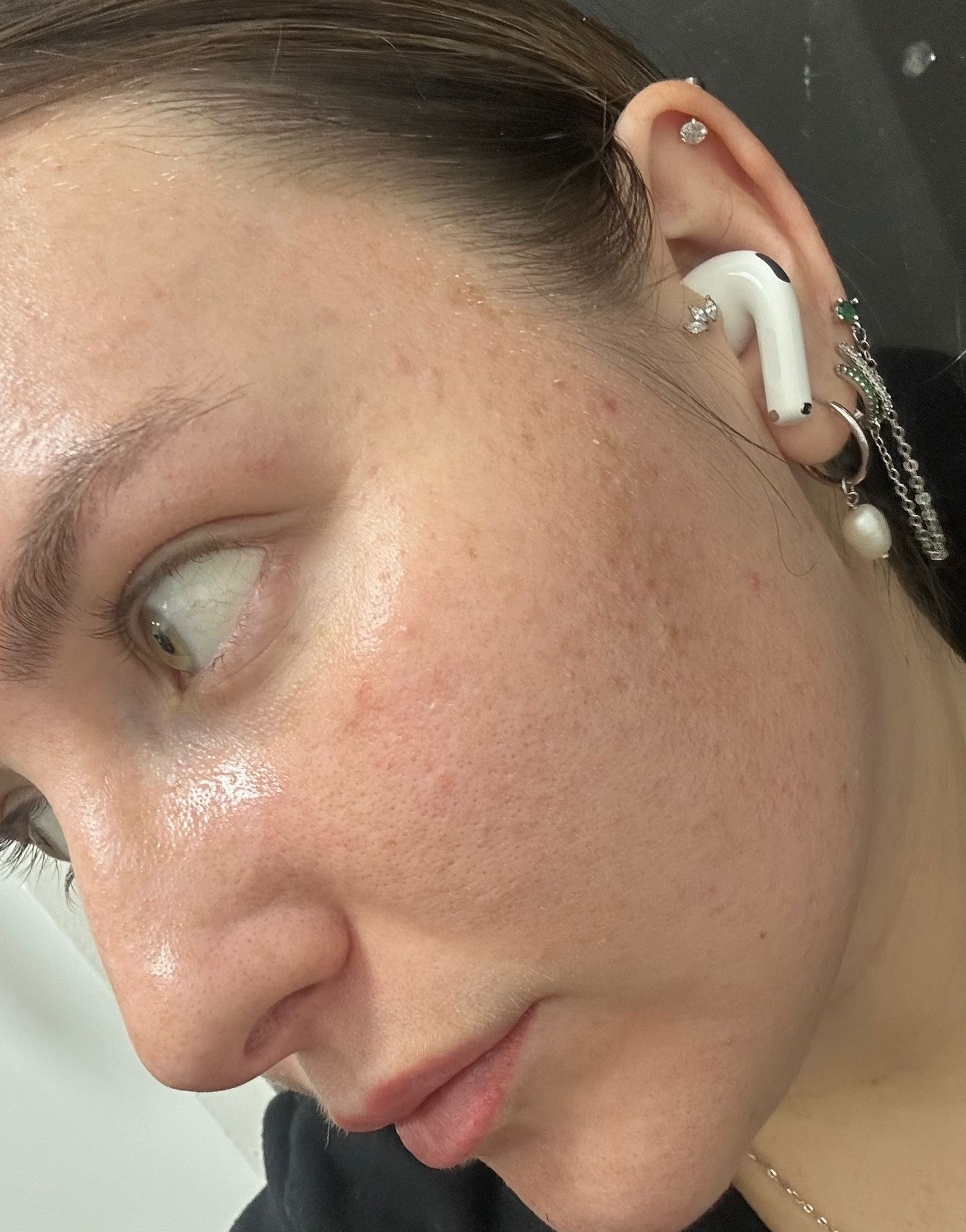 תוצאות טיפול פנים - אחרי הטיפול בקליניקת Alin Cosmetics