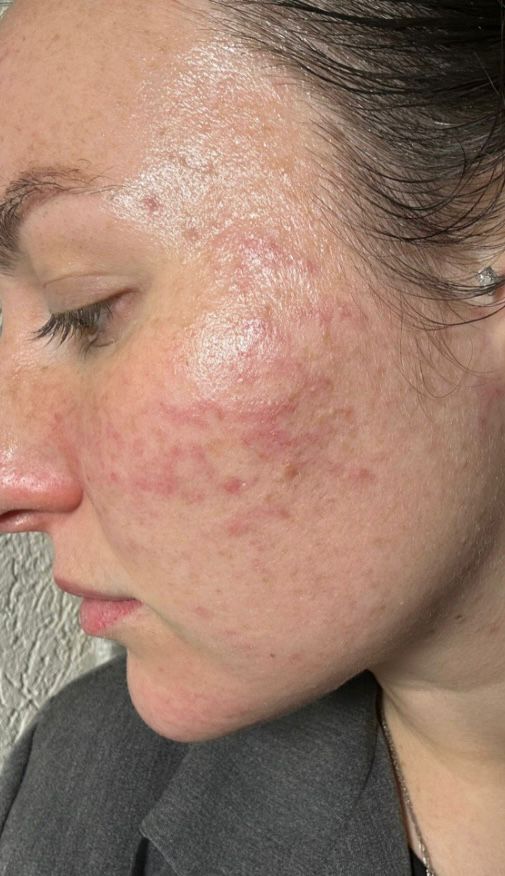 לפני טיפול פנים - מצב העור לפני הטיפול בקליניקת Alin Cosmetics